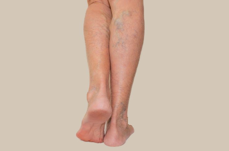 How to Prevent and Manage Varicose Veins • Southwest Florida's Health and  Wellness Magazine