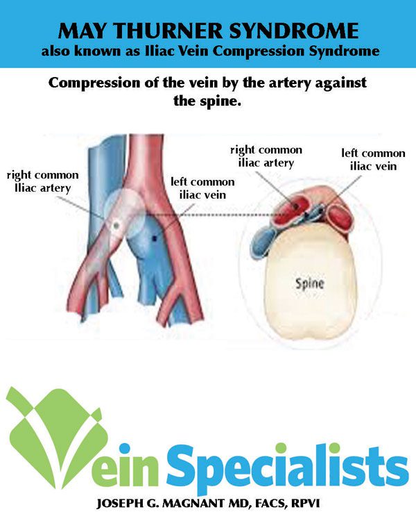 Pelvic Congestion Syndrome - Laser Vascular Center