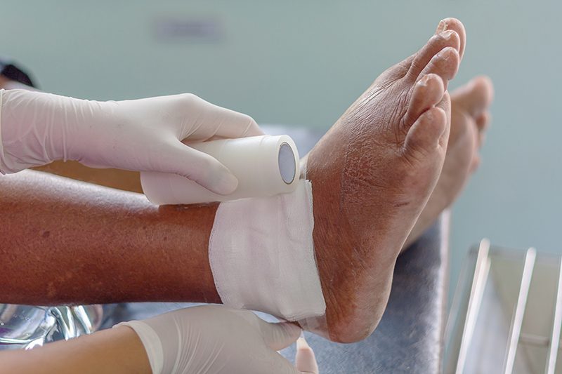 wound of vein care chronic wound patient